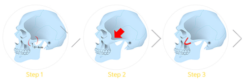 韓國珠兒麗整形醫(yī)院顴骨手術(shù)