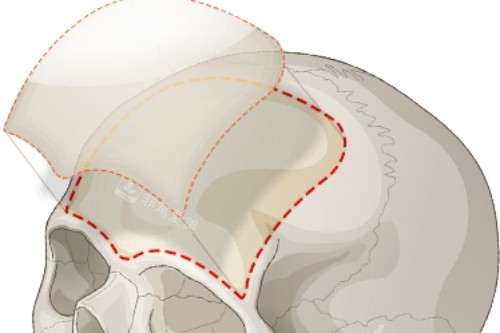 額頭整形骨骼展示圖