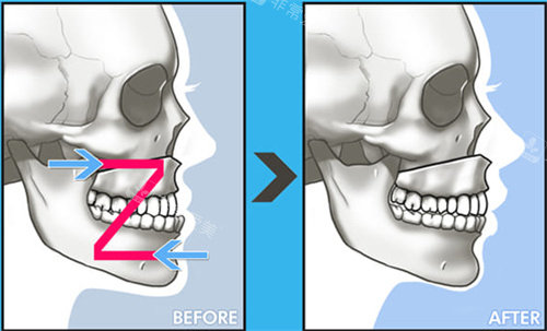 雙鄂手術(shù)前后對(duì)比圖