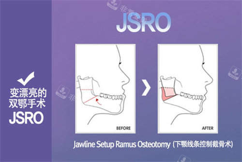 肥死莱茵JSRO图解