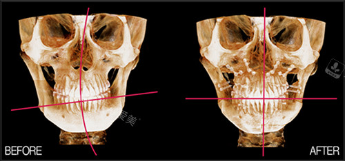 李真秀院长面部不对称前后图