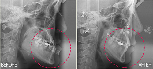 李真秀院长咬合不对称矫正对比图