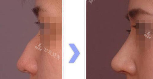 韩国NJH卢钟勋整形隆鼻靠谱吗，公布医生技术特点！