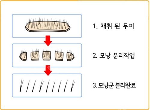 植发提取毛囊过程示意图