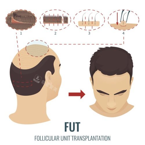 FUT植发过程演示图