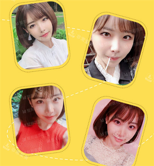 韓國id李知赫輪廓三件套真人實(shí)例術(shù)后圖 韓國id李知赫輪廓三件套真人實(shí)例術(shù)后圖