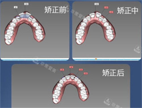 牙齒矯正數(shù)字化設(shè)計(jì)圖