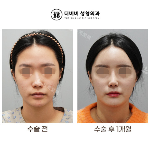 韩国THE BB整形外科鼻整形对比