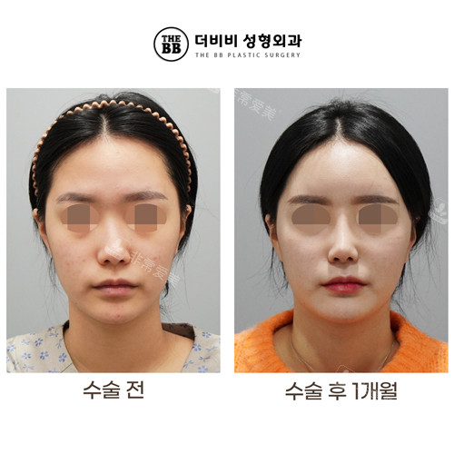韓國THE BB整形外科鼻整形對比 韓國THE BB整形外科鼻整形對比