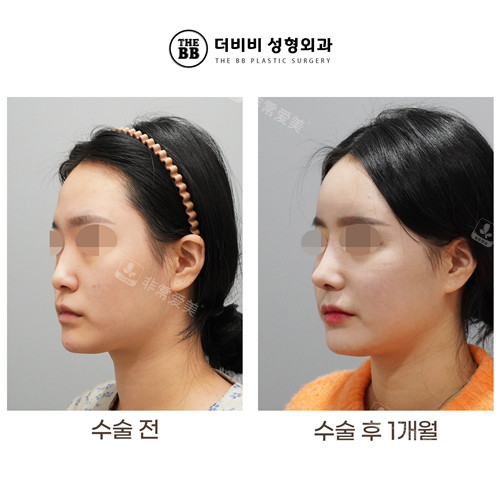 韓國THE BB整形外科鼻整形前后圖 韓國THE BB整形外科鼻整形前后圖
