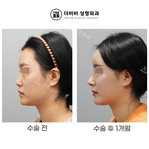 韓國THE BB整形外科鼻整形對比照 韓國THE BB整形外科鼻整形對比照