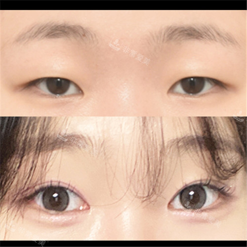韩国ICON整形外科埋线双眼皮对比照