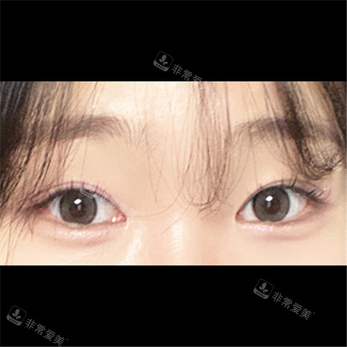 韩国ICON整形外科埋线双眼皮术后形态