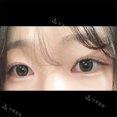 韩国ICON整形外科埋线双眼皮术后图片