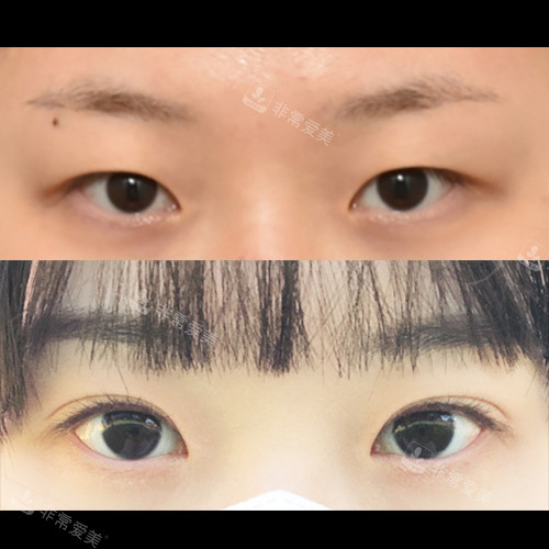 韓國(guó)ICON(圖標(biāo))整形醫(yī)院眼整形對(duì)比照 韓國(guó)ICON(圖標(biāo))整形醫(yī)院眼整形對(duì)比照
