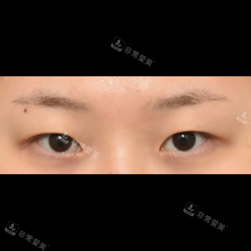 韩国ICON（图标）整形医院眼整形术前图