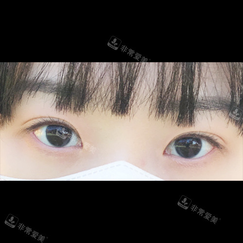 韩国ICON（图标）整形医院眼整形术后照片