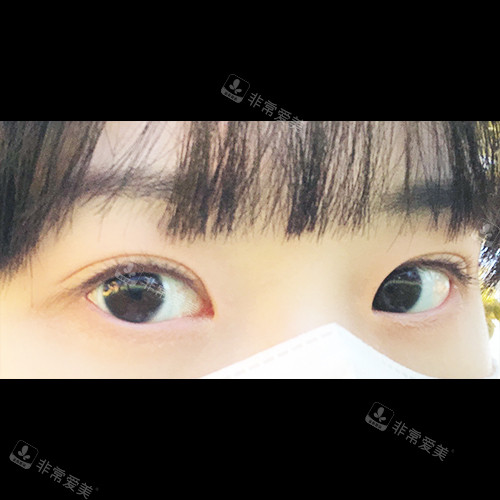 韩国ICON（图标）整形医院眼整形术后眼睛情况