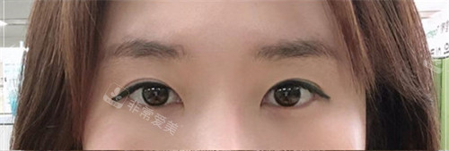 韩国欧佩拉OPERA整形外科眼部整形术前图