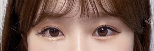韩国欧佩拉OPERA整形外科眼部整形术后图