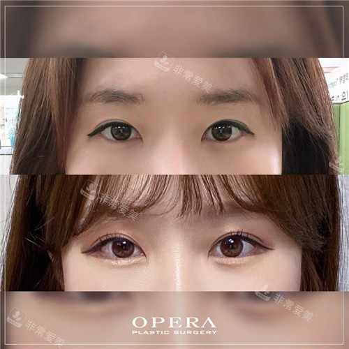 韩国欧佩拉OPERA整形外科眼部整形对比照