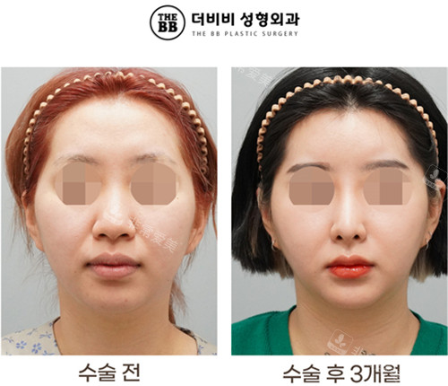 韩国得芘芘整形外科鼻整形前后对比图
