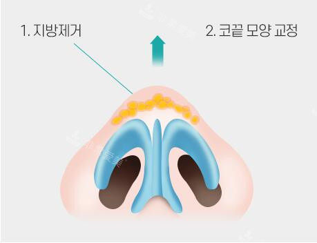 鼻头圆钝怎么改变?韩国温度整形钝平鼻尖矫正术改善钝鼻头