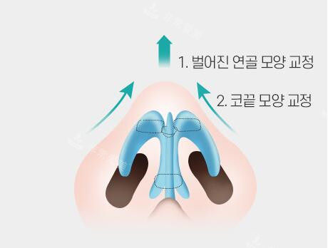 鼻头塑形示意图