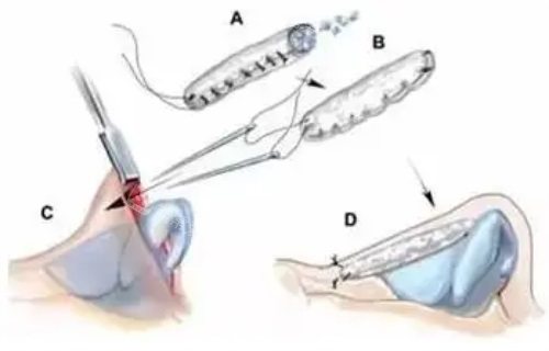 鼻修復(fù)過程圖