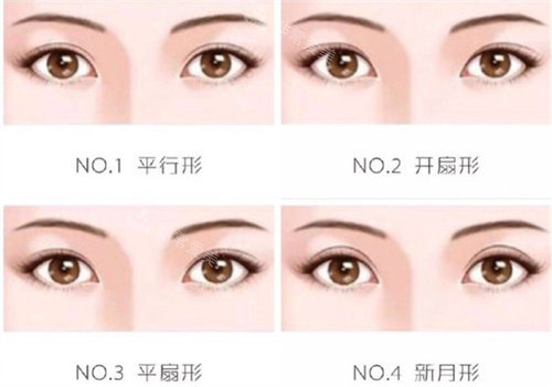 雙眼皮不同形狀示意圖 雙眼皮不同形狀示意圖