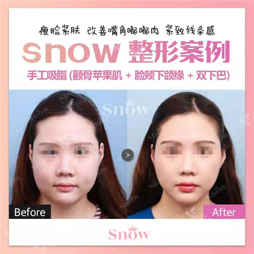 Snow整形医院手工吸脂3件套前后图