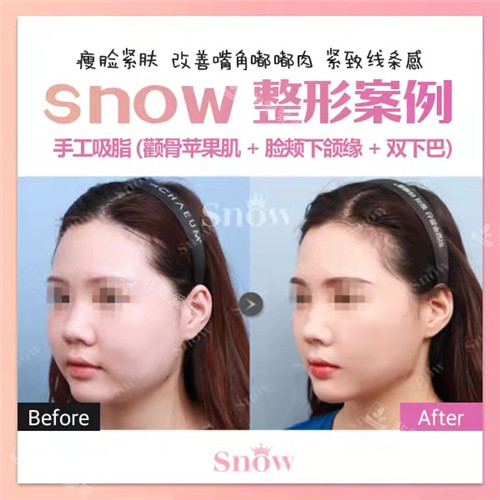 Snow整形医院手工吸脂3件套对比照