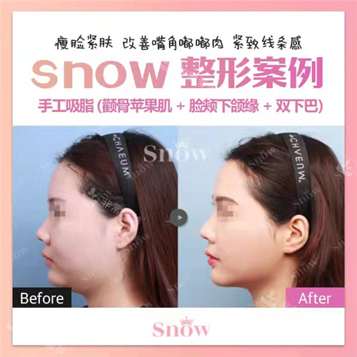 Snow整形医院手工吸脂3件套对比展示图