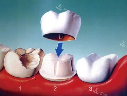 戴牙冠示意图