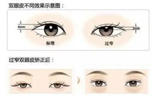 不同类型的双眼皮示意图 不同类型的双眼皮示意图