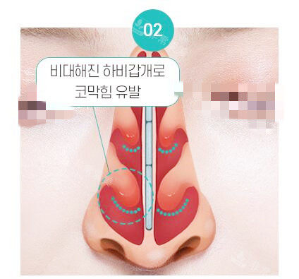 鼻中隔弯曲引起炎症图示
