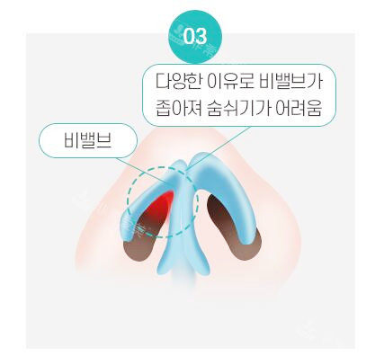 鼻中隔厚而彎曲造成狹窄圖示 鼻中隔厚而彎曲造成狹窄圖示