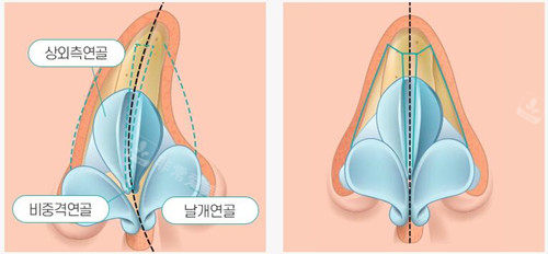 鼻中隔矯正前后圖示 鼻中隔矯正前后圖示