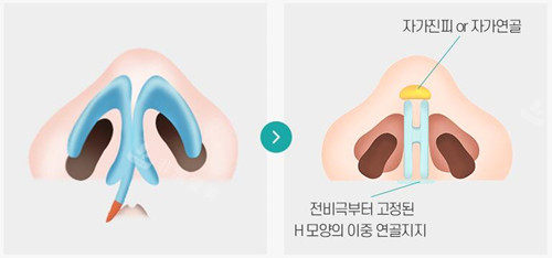 H雙固定方法圖示