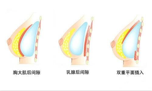 隆胸示意图