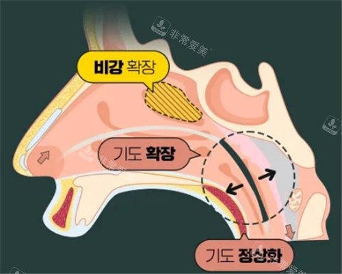 鼻部功能性改善