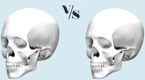 韩国欧佩拉整形下颌角手术特点展示