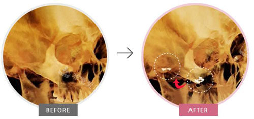 韩国欧佩拉整形颧骨缩小对比图