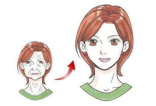 埋線提升示意圖