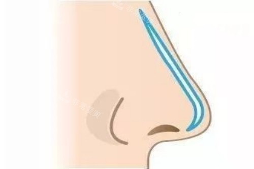 隆鼻手术动画示意图