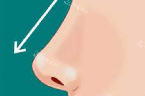 隆鼻手术示意图