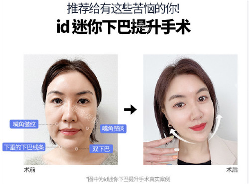 韓國ID醫(yī)院下巴迷你提升術(shù)對比照