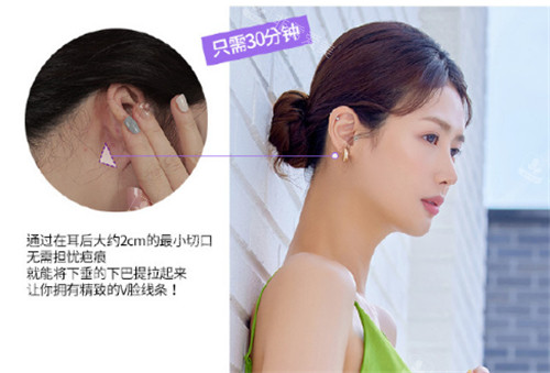 韓國ID醫(yī)院下巴迷你提升術(shù)手術(shù)方式介紹