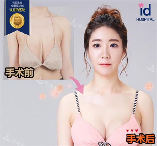 韓國ID醫(yī)院做縮胸手術(shù)前后對比照 韓國ID醫(yī)院做縮胸手術(shù)前后對比照