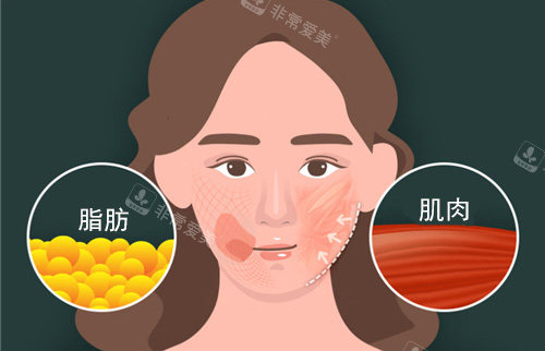 面部脂肪和面部肌肉
